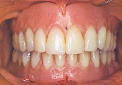 <font face="verdana,geneva" size="2">Eksik doğal dişler yerine ise, yine akrilik veya porselen hazır takım dişler kullanılır.<br /><br />Bir ya da birden fazla dişin eksik olduğu durumlarda yapılan Hareketli Protez tipine; </font><a href="http://dentalstudyo.com/parsiyel.htm"><font face="verdana,geneva" size="2">Hareketli Parsiyel (B&ouml;l&uuml;ml&uuml;) Protez,</font></a><br /><br /><font face="verdana,geneva" size="2">T&uuml;m doğal dişlerin eksik olduğu durumda yapılan tipine ise; </font><a href="http://dentalstudyo.com/tamprotez.htm"><font face="verdana,geneva" size="2">Tam Protez</font></a><font face="verdana,geneva" size="2"> adı verilir.</font>