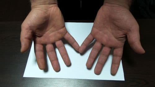 Meslek hastalığın var dediler ama maluliyet vermediler