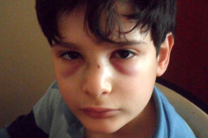 Okulda burnu kırılan çocuğun annesinden şok iddia