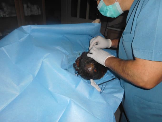Sokak köpeğinin karın altındaki tümör alındı