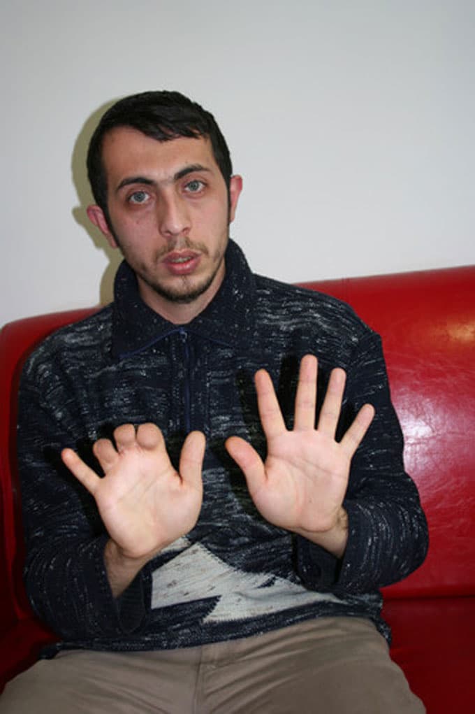 Askerde parmakları ezildi, 6 yıldır hayatı karardı