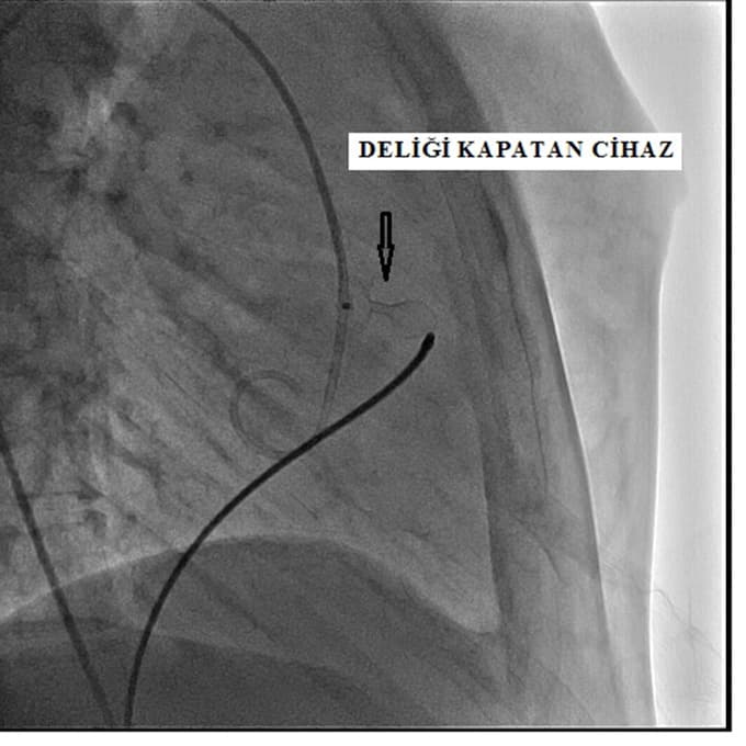 Kalp deliği kapalı ameliyatla tedavi edildi