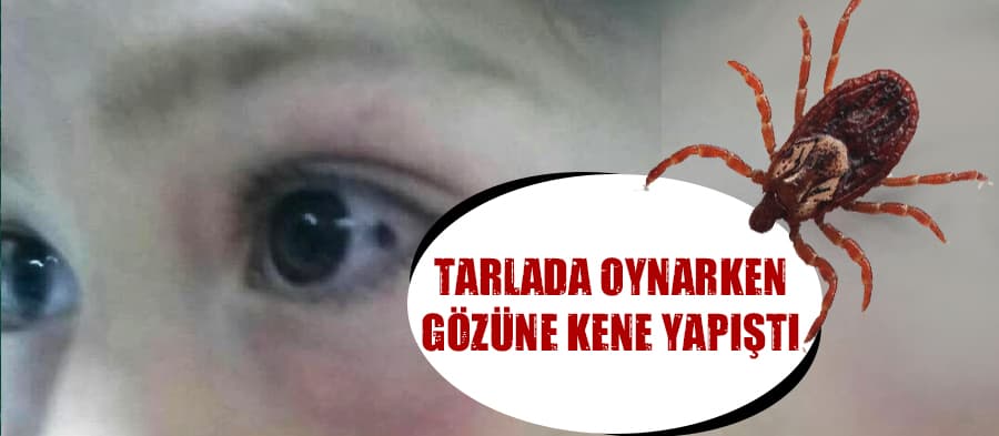 Tarlada oynarken gözüne kene yapıştı
