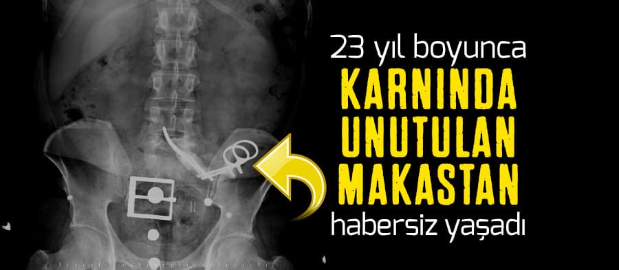 23 yıl karnında unutulan makasla yaşadı