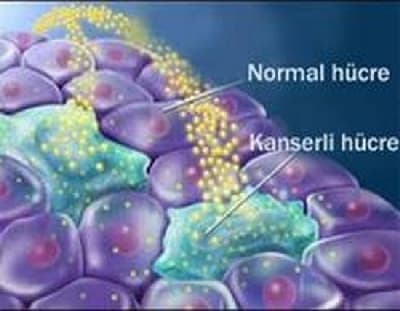 <p><font face="arial,helvetica,sans-serif" size="2">Molecular Cell dergisinde yayınlanan en son araştırmada, ilk kez WT1 h&uuml;crelerini yok eden enzimin keşfedildiği a&ccedil;ıklandı. Manchester's &Uuml;niversitesi Yaşam Bilimleri Fak&uuml;ltesi'nden Dr Jorg Hartkamp, &quot;<font color="#333399">Kansere WT1'in yol a&ccedil;tığı yıllardır biliniyordu. Ancak, bunun nasıl işlediği anlaşılamamıştı. B&ouml;ylece, WT1'in d&uuml;zenleyici etki alanı &uuml;zerinde &ccedil;alışırken, kazayla proteaz HtrA2'nin rol&uuml;n&uuml; keşfettik. Bu keşif daha b&uuml;y&uuml;k etkiye sahip. WT1'in eksik yerlerini doldurduk. Bu eksik yerler de enzimin WT1 h&uuml;crelerini temizleyebilmesidir</font>&quot; diye konuştu.</font> </p>
