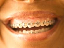 Ağız ve Diş Sağlığı - Ortodonti