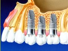 Ağız ve Diş Sağlığı - Dental İmplantlar